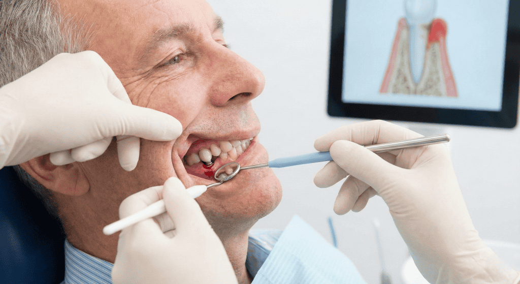 אילו סימנים מעידים על דחיית שתל שיניים?